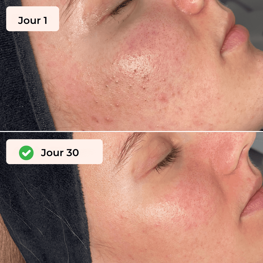 Gant Exfoliant Poils Incarnés